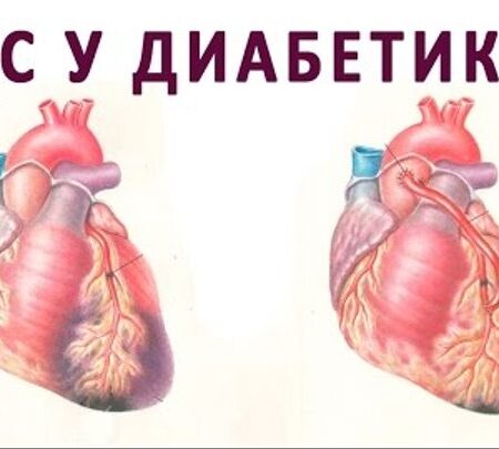 Диабет второго типа: новая угроза для сердца
