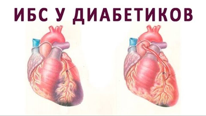 Preview Диабет второго типа: новая угроза для сердца