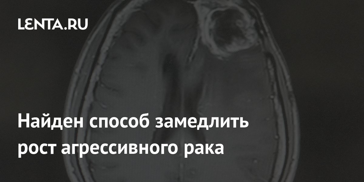 Preview Открыт метод замедления прогрессирования агрессивного рака мозга