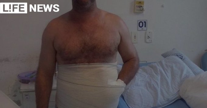 Preview Уникальная операция: ладонь восстановлена с помощью кожи с живота