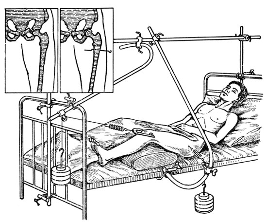 Preview Устройство для моментального лечения сложных переломов: Прорыв в медицине